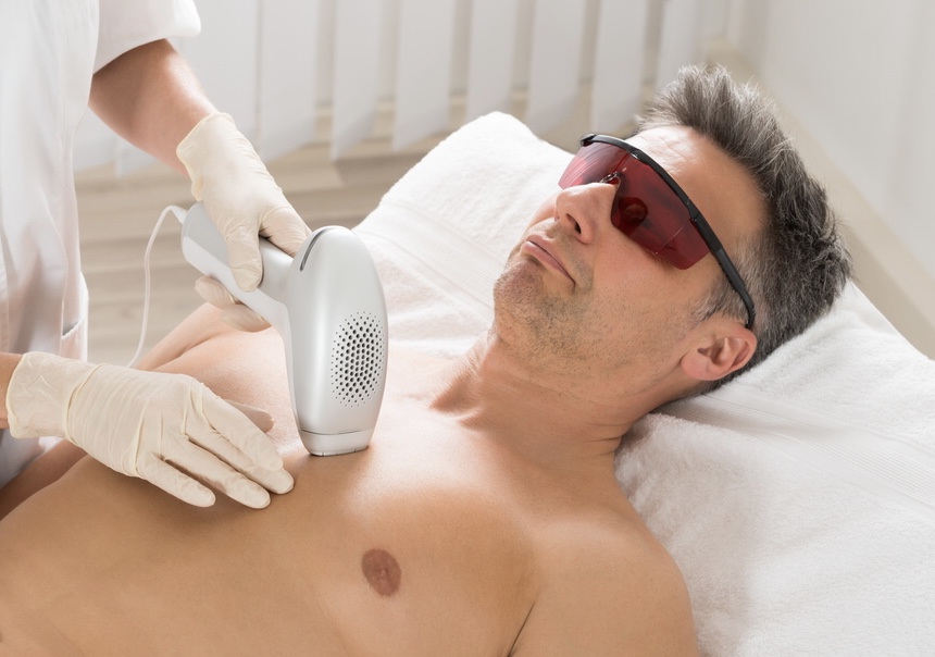 Laser Hair Removal