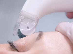 micro-needling. collagen induction therapy